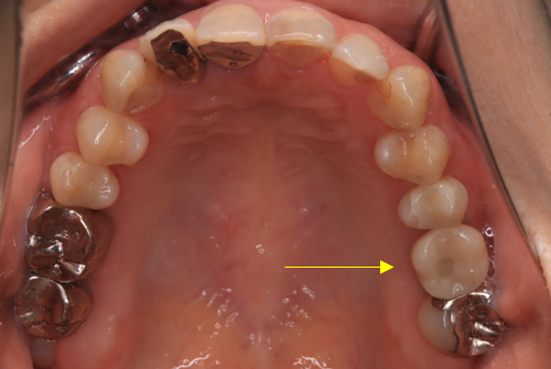 当院でのインプラント症例② 短いインプラントを利用し、低侵襲（痛くない・腫れない・予算を抑えたケース）after