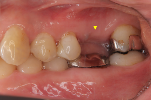当院でのインプラント症例② 短いインプラントを利用し、低侵襲（痛くない・腫れない・予算を抑えたケース）before