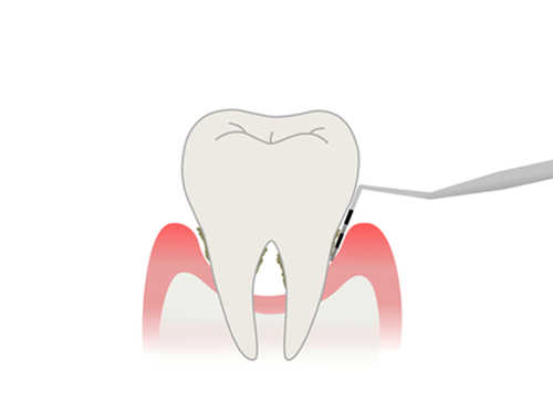 歯周病についての詳しい説明と、歯周病になっているかどうかの検査を行います。