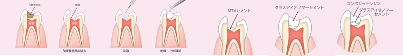 歯の神経を守るMTAセメント