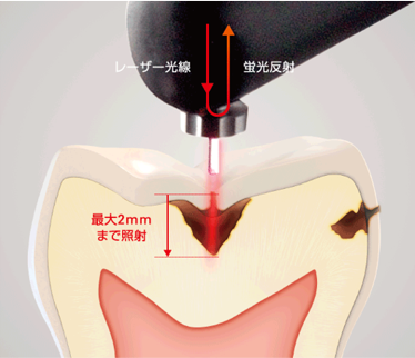 1番大事なのは虫歯予防、また早期発見です。